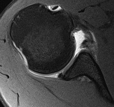 Shoulder MRI Anterior Bankart